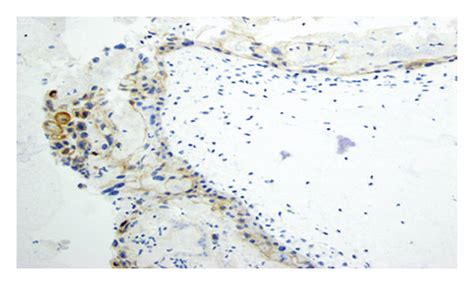 Complete hydatidiform mole slides. Histology and immunohistochemistry... | Download Scientific ...