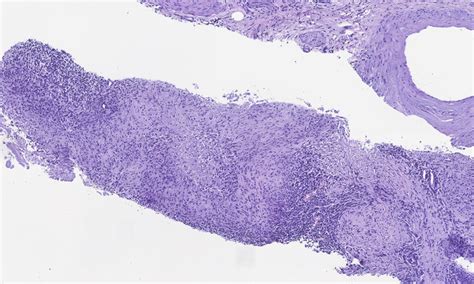 H E Stained Slide X From A Prostate Needle Core Biopsy With