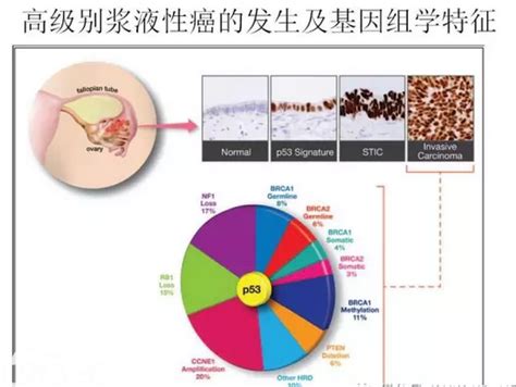 卵巢癌的病理诊断新进展（一） 病理杂谈 91360病理论坛