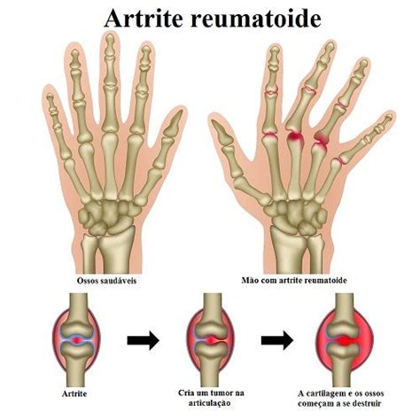 Existe cura para a artrite reumatoide Melhor saúde