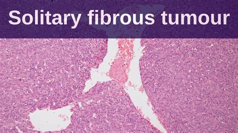 Solitary Fibrous Tumour Pathology Mini Tutorial YouTube