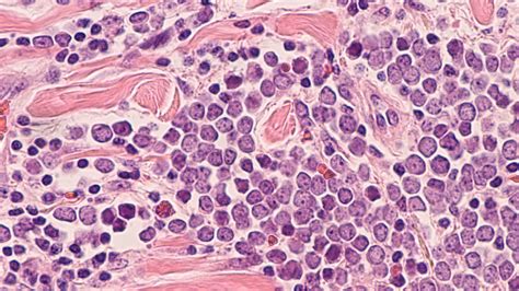 What to know about Merkel cell carcinoma, the rare skin cancer that led ...