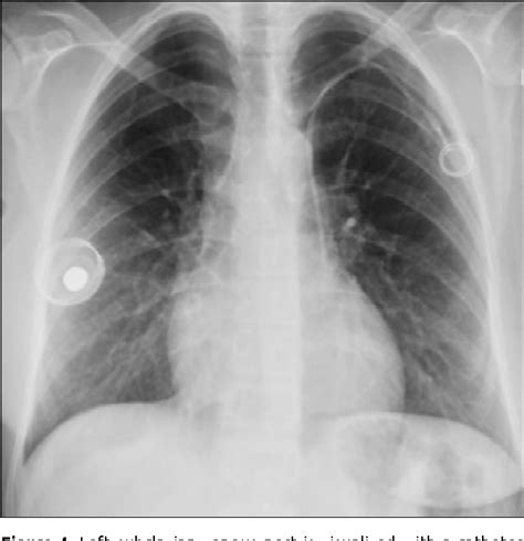 Figure 1 From Persistent Left Superior Vena Cava Incidentally Recognized Postoperatively After