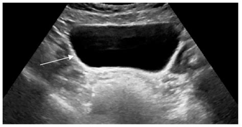 Primary Adrenal Insufficiency Complete Sex Reversal And Unique