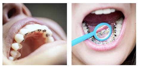 What Are Lingual Braces A Complete Guide Tisseront Orthodontics