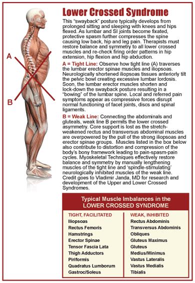 Upper Crossed Syndrome And Lower Crossed Syndrome Poster 48 Off