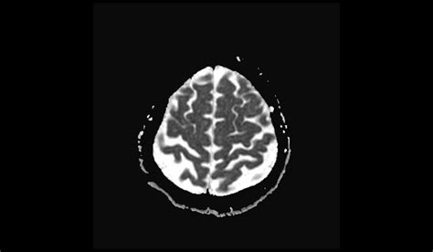 Tuberculoma MRI | Radiology Article on Brain Tuberculoma