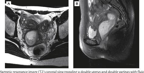 Figure 1 From Uterine Didelphys In A Pregnant Mother