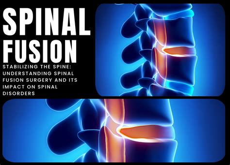 Spinal Fusion Procedure Indications And Recovery