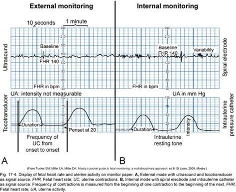 Fetal Heart Rate Monitoring Flashcards Quizlet