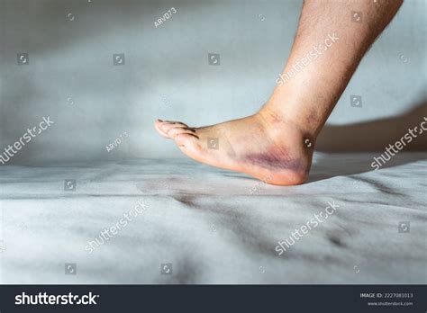 Sprained Swollen Anklemans Sprained Ankle Homeankle Stock Photo