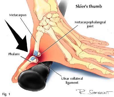 Thumb Injuries: The Complete Guide to Diagnosing your Thumb Pain | Thumb pain, Skier, Ligament tear