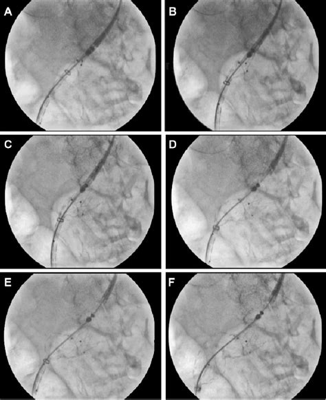 Figure 3 From Push Up Technique And Anatomical Deployment With The