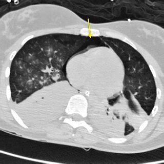 Chest CT scan. Arrow shows air in the mediastinum. | Download Scientific Diagram