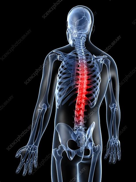 Human Back Pain Artwork Stock Image F010 5635 Science Photo Library