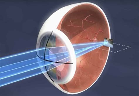 Astigmatismo Qu Es Y C Mo Se Trata Rea Oftalmol Gica Avanzada