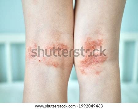 Dermatitis Close Up Stock Photos And Images Avopix