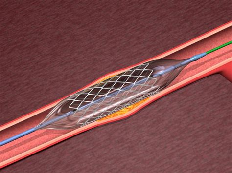 Angioplasty With Vascular Stenting