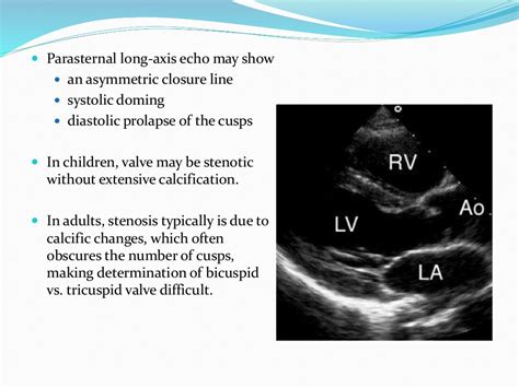 Aortic Stenosis Echo Guidelines