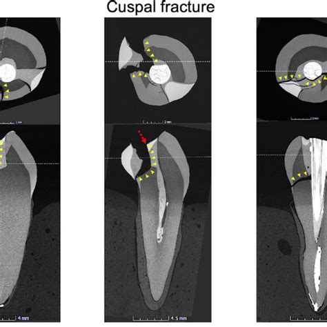 Micro CT Images Showing Different Fractures Modes In The Cyclic Loading