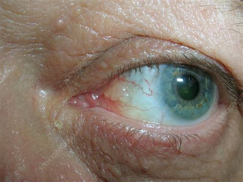 Conjunctival Cyst Stock Image C0560890 Science Photo Library