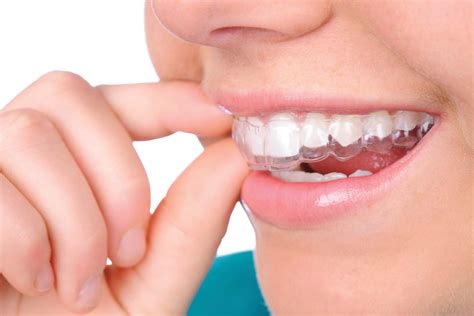 Invisalign® Orthodontic Treatment Healthscopehealthscope