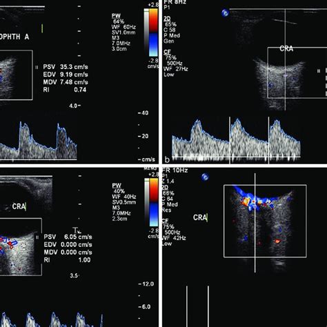 A Color Doppler Image Cdi Showing Normal Color Flow And Spectral