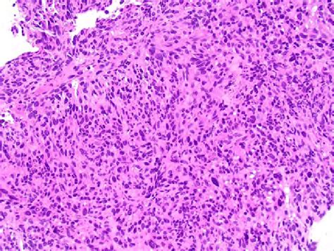 Leiomyosarcoma The Tumour Is Composed Of Long Fascicles Of