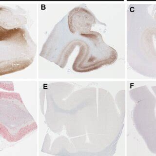 Distribution Of Age Braak Neurofibrillary Tangle Nft Stage And