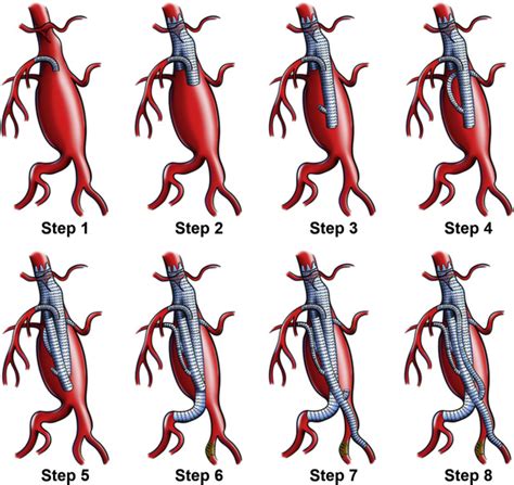 References In Successful Use Of Retrograde Branched Extension Limb