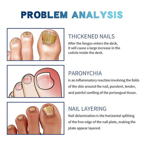 Toenail Fungus Treatment, Nail Fungus Treatment Pen, Nail Repair