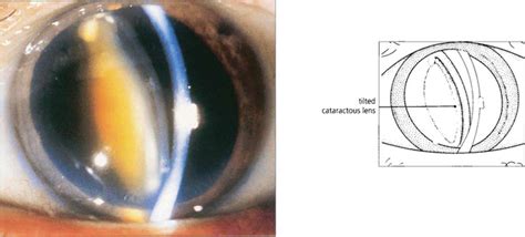 Secondary Glaucoma Clinical Gate