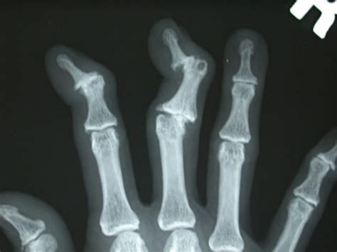 Deformities of the Hand | Hand Surgery Associates