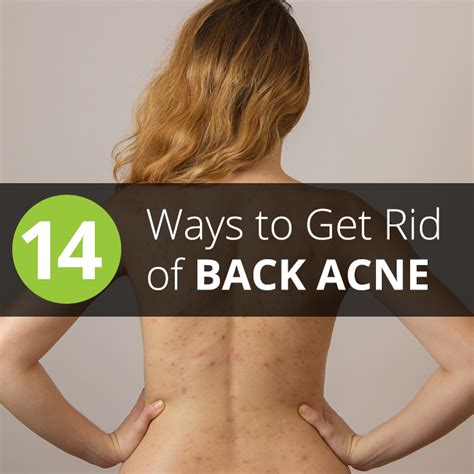 14 Ways To Get Rid Of Back Acne Bacne At Home In 20 Minutes Or Less