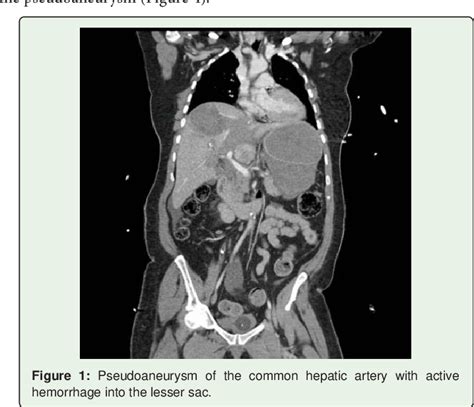 Figure 1 From Endovascular Stent Graft Repair Of An Acute Traumatic