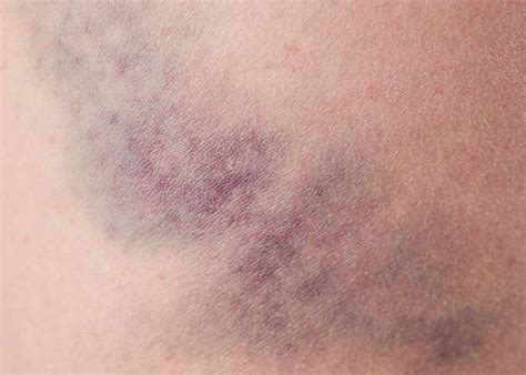 Reasons Why You Bruise Easily By Dr Joseph Mercola