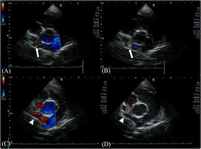 Frontiers Case Report Echocardiographic And Computed Tomographic