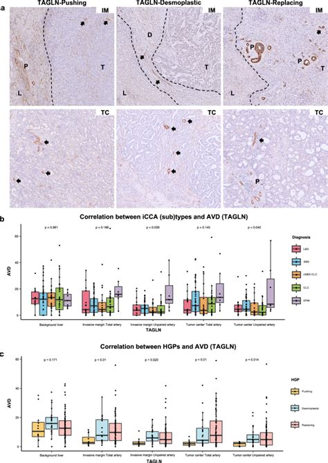 Histopathological Growth Pattern And Vessel Co Option In Intrahepatic Cholangiocarcinoma