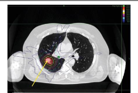 PDF Stereotactic Ablative Body Radiotherapy SABR For Primary And