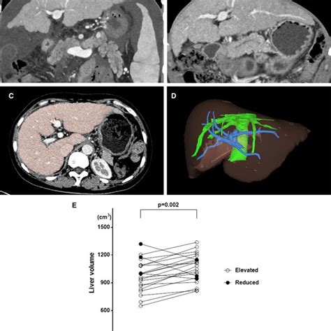 Liver Regeneration Were Observed In Many Patients After Surgery We