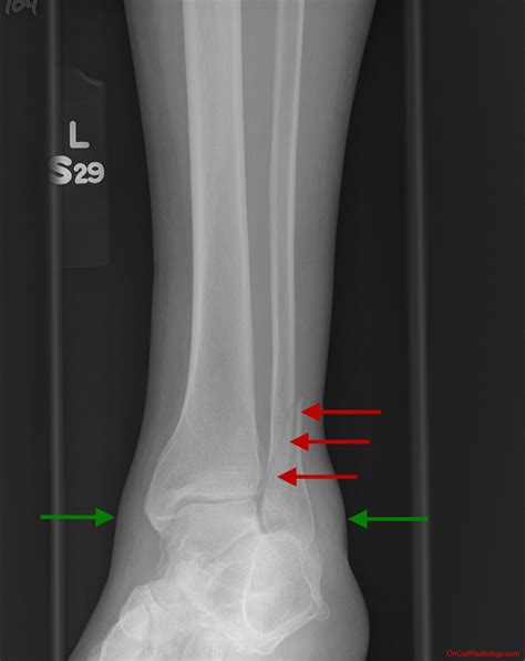 Fractured Fibula X Ray