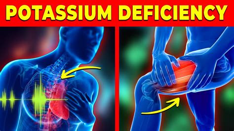 Signs And Symptoms Of Low Potassium Hypokalemia Youtube