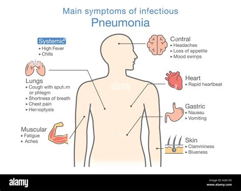 Diagram Of Main Symptoms Of Infectious Pneumonia Stock Vector Image And Art Alamy