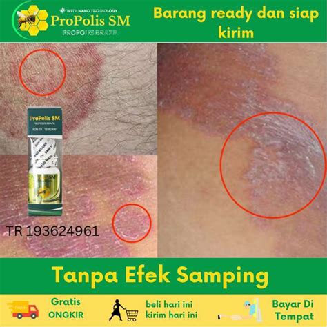 Jual Obat Selangkangan Hitam Dan Gatal Obat Jamur Selangkangan Obat