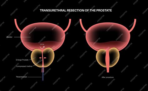 Premium Vector Transurethral Resection Of The Prostate Turp Medical