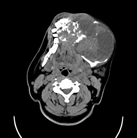 Ameloblastoma Radiology Case Radiopaedia Org