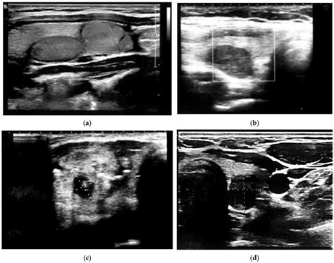 Benign Thyroid Nodules A Halo Isoechoic Solid Nodules Without Download Scientific Diagram