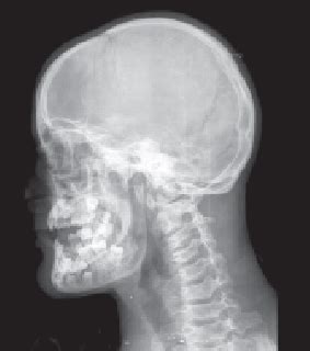 P A Skull Radiograph Showing Open Anterior Fontanelle And Sutures Of