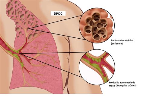 Doença Pulmonar Obstrutiva Crônica DPOC Medicina Respiratória