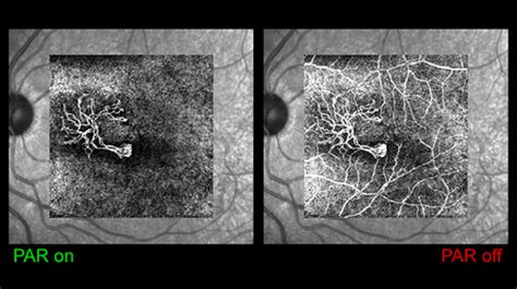 Pathology As Never Seen Before With The Spectralis Oct Angiography